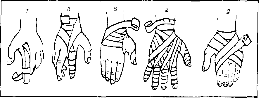 Перевязка руки схема