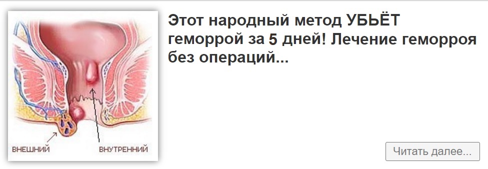 Как лечить геморрой у женщин. Геморрой народные средства.