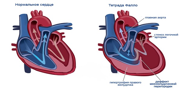 Тетрада фалло картинки